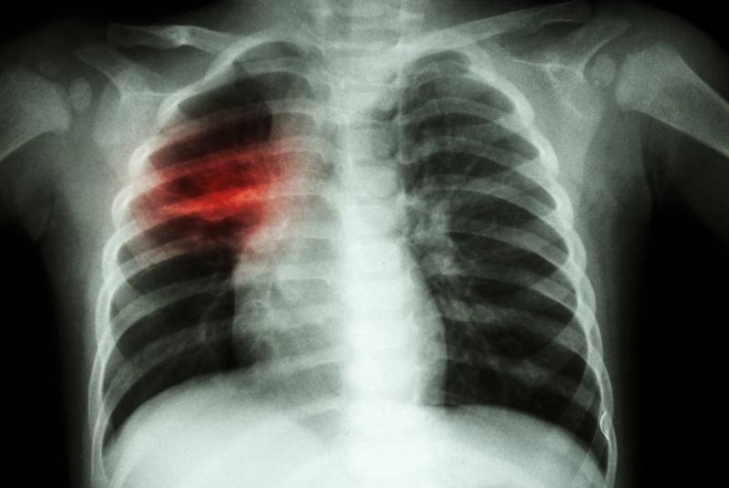 Бум на болни от туберкулоза е отчетен във Врачанско, сочи