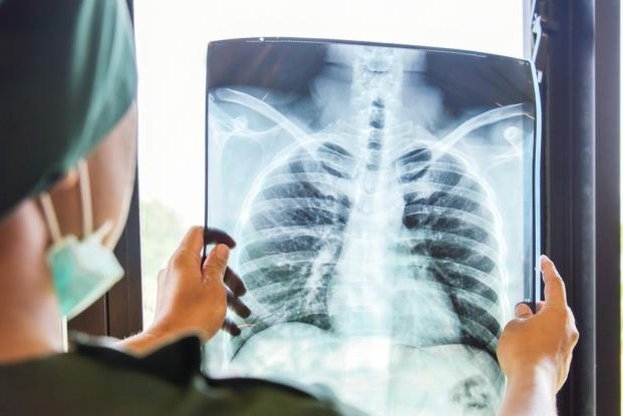 За нов случай на туберкулоза алармират здравните власти в Монтана.